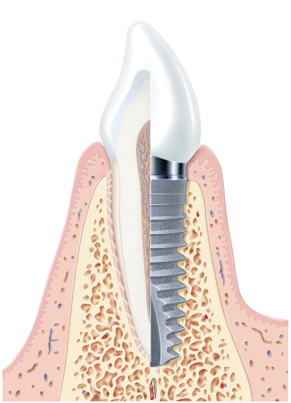 Schematische Darstellung eines Implantats der Fa. Xive