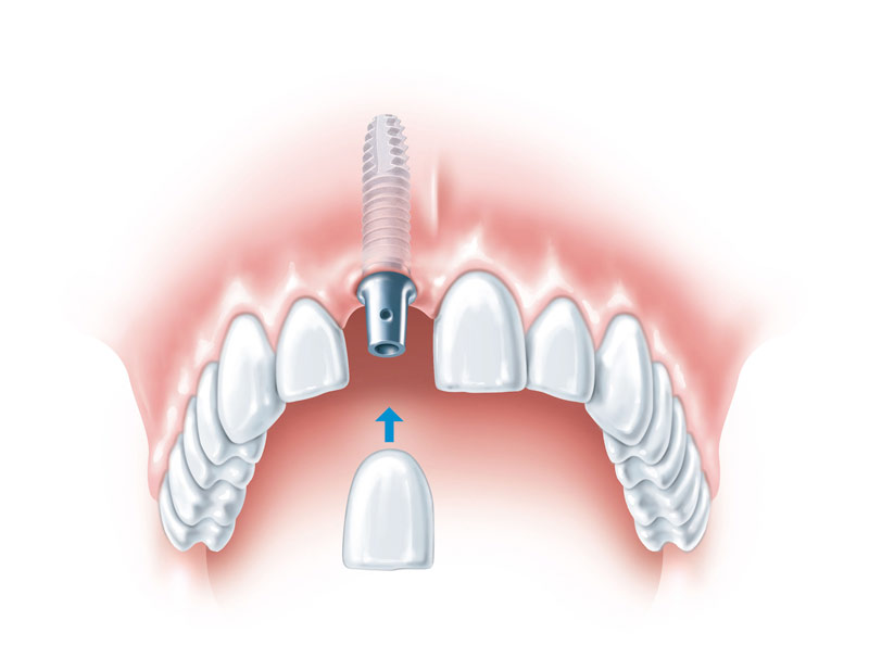 Schematische Darstellung einer implantatverankerten Krone